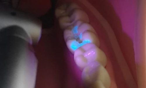 bluelight